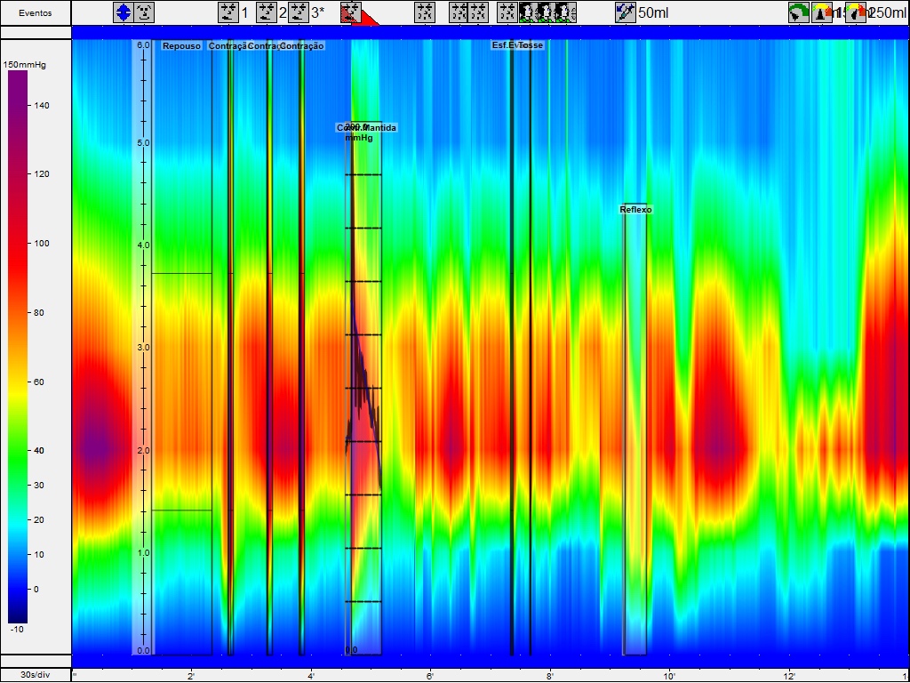Manometria anorretal de alta resolução
