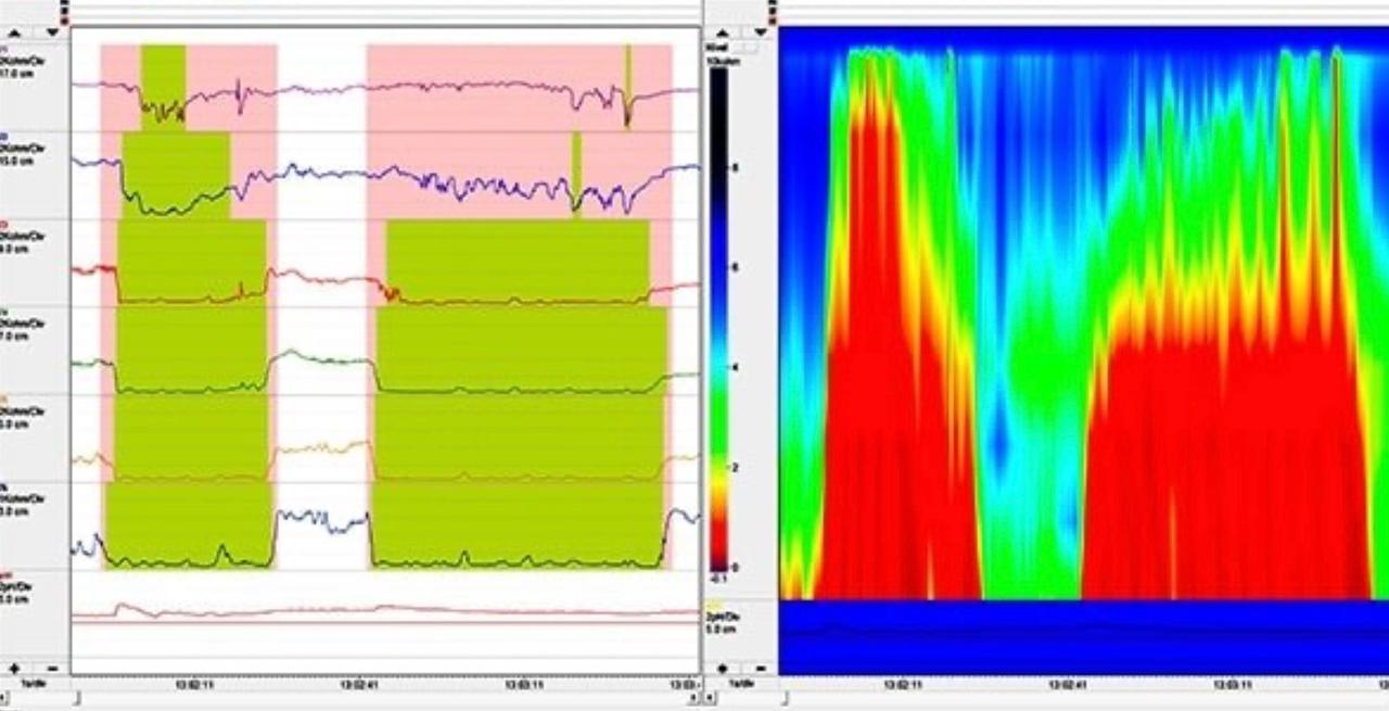 Impedâncio phmetria esofágica de 24h